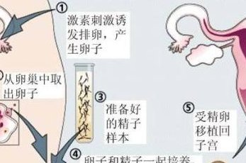 2026年去四川做三代试管婴儿难受么？